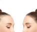 hairloss_mydreamsalon